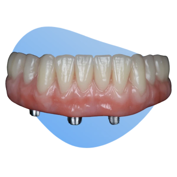 A dental implant with a blue background.